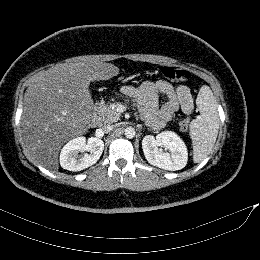 Acute on chronic pancreatitis (Radiopaedia 80902-94423 Axial C+ portal venous phase 60).jpg