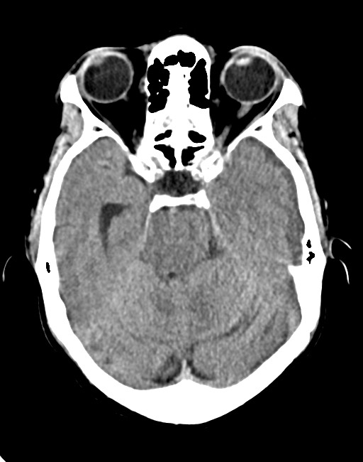 Acute on chronic subdural hematoma (Radiopaedia 74814-85823 Axial non-contrast 37).jpg