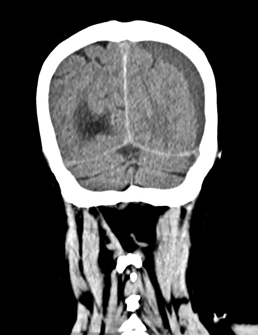 Acute on chronic subdural hematoma (Radiopaedia 74814-85823 Coronal non-contrast 54).jpg