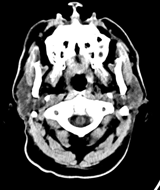 Acute on chronic subdural hematoma (Radiopaedia 78346-90966 Axial non-contrast 9).jpg