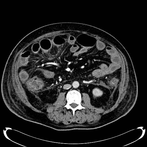 Acute pancreatic necrosis (Radiopaedia 13560-18500 Axial C+ portal venous phase 86).jpg