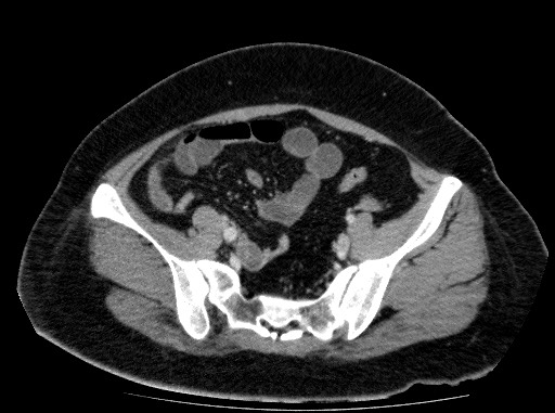 Acute pancreatitis (Radiopaedia 69236-79012 Axial C+ portal venous phase 72).jpg