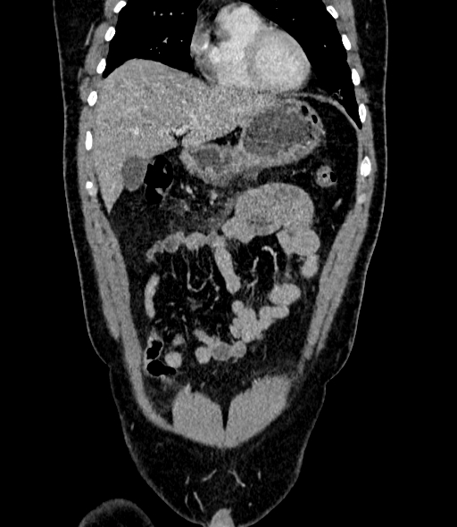 Acute pancreatitis (Radiopaedia 87428-103757 Coronal C+ portal venous phase 25).jpg