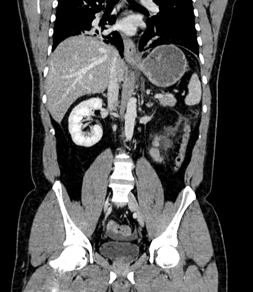 File:Acute pancreatitis (Radiopaedia 87428-103757 Coronal C+ portal venous phase 54).jpg