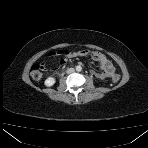 Acute pancreatitis - Balthazar C (Radiopaedia 26569-26714 Axial C+ portal venous phase 55).jpg