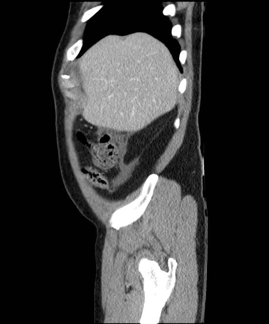 Acute pancreatitis - Balthazar E (Radiopaedia 23080-23110 Sagittal C+ portal venous phase 11).jpg