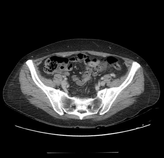 Acute pancreatitis - Balthazar E - post ERCP (Radiopaedia 27562-27772 Axial C+ portal venous phase 59).png