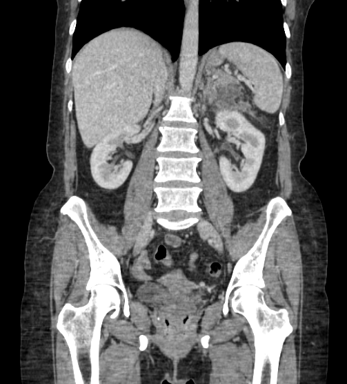 File:Acute pancreatitis - Balthazar E - post ERCP (Radiopaedia 27562-27772 Coronal C+ portal venous phase 51).png