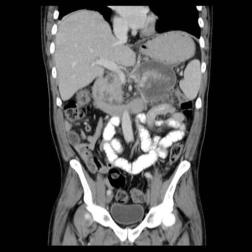 File:Acute pancreatitis with walled off pancreatic necrosis (Radiopaedia 6438-7797 Coronal C+ portal venous phase 5).jpg