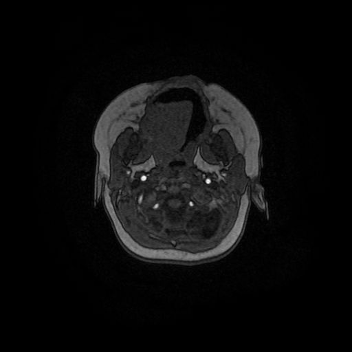 Acute phase of hemiconvulsion-hemiplegia epilepsy syndrome (Radiopaedia 29309-29745 Axial TOF angiography 159).jpg