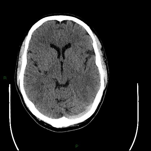 Acute posterior cerebral artery territory infarct (Radiopaedia 79329-92393 Axial non-contrast 48).jpg