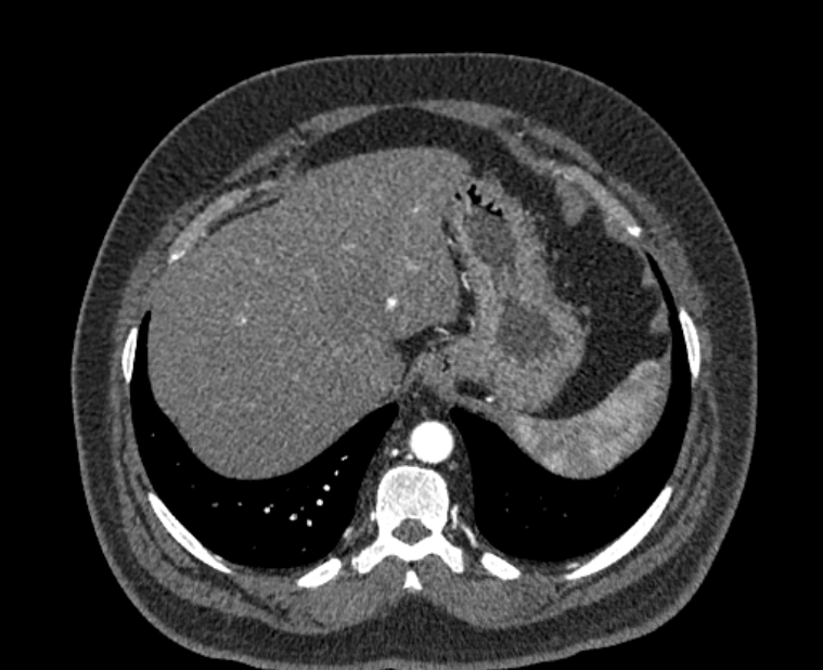 Acute pulmonary embolism with pulmonary infarcts (Radiopaedia 77688-89908 Axial C+ CTPA 60).jpg