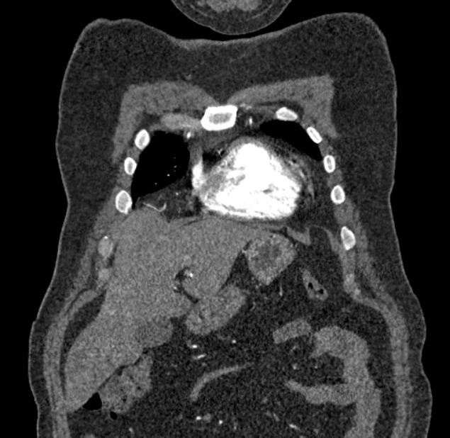 Acute pulmonary embolism with pulmonary infarcts (Radiopaedia 77688-89908 Coronal C+ CTPA 1).jpg