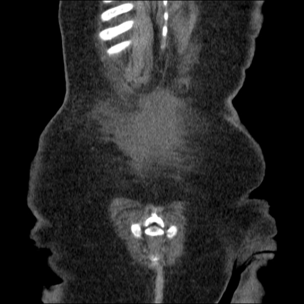 Acute pyelonephritis (Radiopaedia 26584-26729 C+ portal venous phase 70).jpg