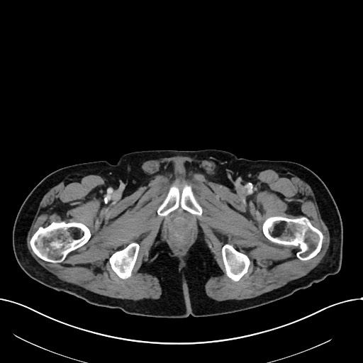 Acute renal infarction (Radiopaedia 59375-66736 Axial C+ portal venous phase 126).jpg
