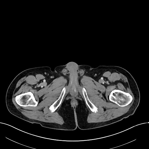 Acute renal infarction (Radiopaedia 59375-66736 Axial C+ portal venous phase 133).jpg
