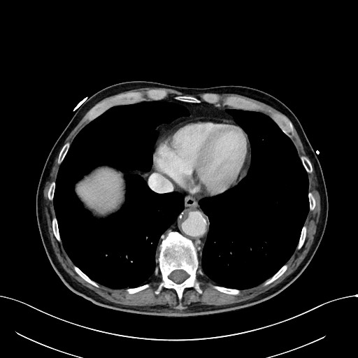 Acute renal infarction (Radiopaedia 59375-66736 Axial C+ portal venous phase 4).jpg