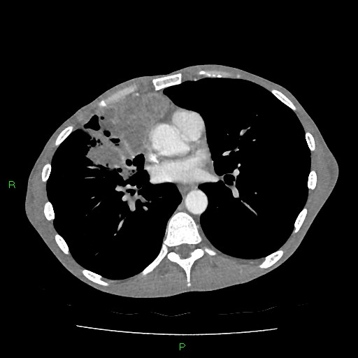 File:Acute right lung abscess (Radiopaedia 34806-36258 Axial C+ arterial phase 104).jpg