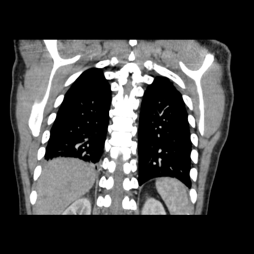 Acute segmental pulmonary emboli and pulmonary infarction (Radiopaedia 62264-70444 Coronal C+ CTPA 44).jpg
