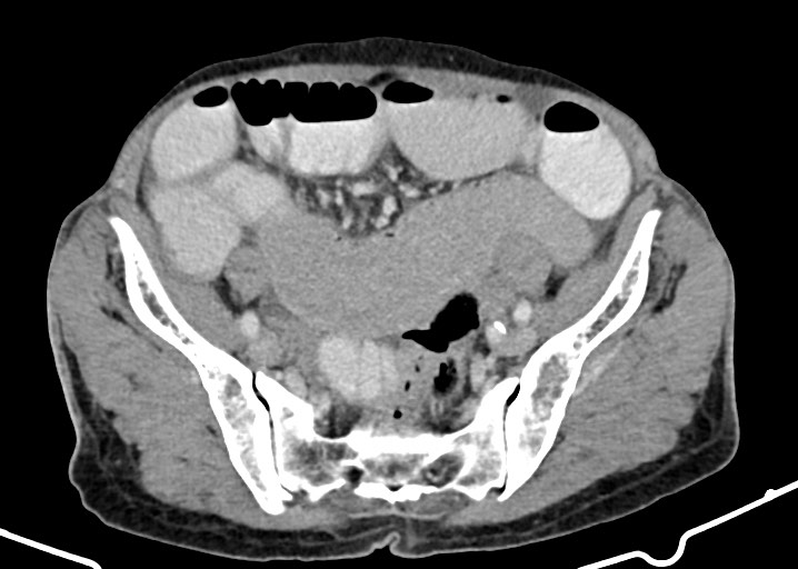 Acute small bowel (ileal) volvulus (Radiopaedia 71740-82139 Axial C+ portal venous phase 154).jpg