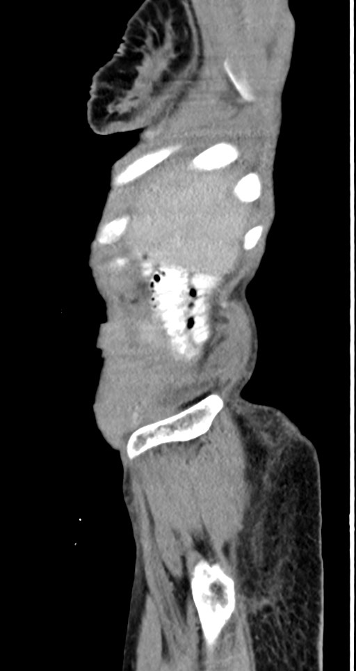 Acute small bowel (ileal) volvulus (Radiopaedia 71740-82139 Sagittal C+ portal venous phase 146).jpg