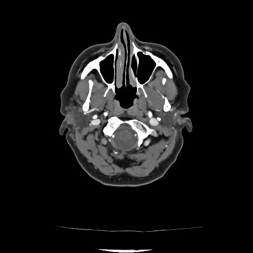Acute subarachnoid hemorrhage and accessory anterior cerebral artery (Radiopaedia 69231-79009 Axial C+ arterial phase 74).jpg