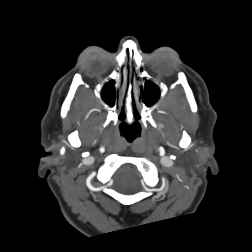 Acute subarachnoid hemorrhage and accessory anterior cerebral artery (Radiopaedia 69231-79009 D 7).jpg