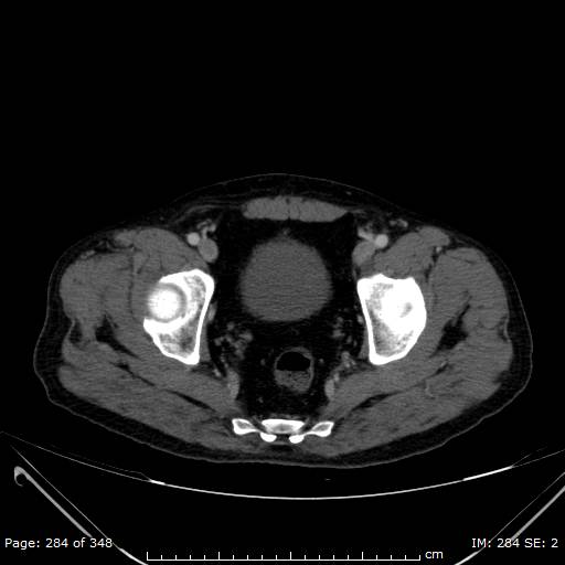 Acute superior mesenteric artery occlusion (Radiopaedia 43636-47060 Axial C+ portal venous phase 58).jpg
