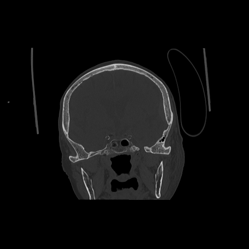 Acute traumatic subdural hematoma (Radiopaedia 82921-97257 Axial bone window 1).jpg