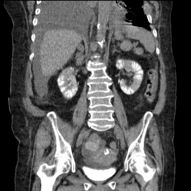Acute tubular necrosis (Radiopaedia 28077-28334 G 53).jpg