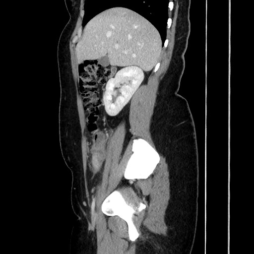 Acute uncomplicated appendicitis (Radiopaedia 73704-84499 Sagittal C+ portal venous phase 81).jpg