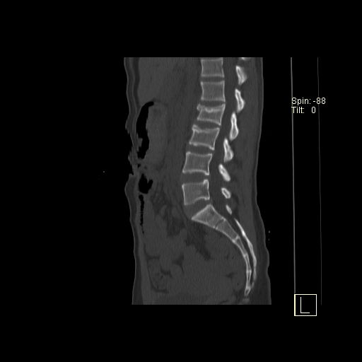 File:Acute vertebral compression fracture (Radiopaedia 63832-72559 Sagittal bone window 14).jpg