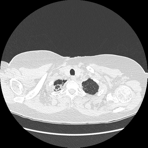 Adenocarcinoma in situ of lung (Radiopaedia 38685-40829 B 17).png