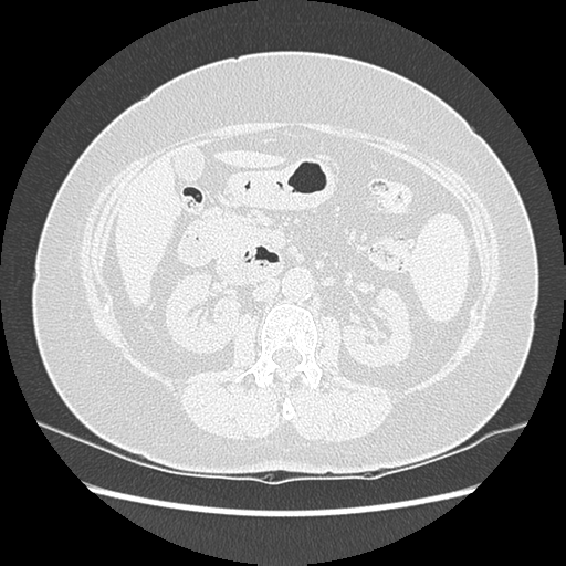Adenocarcinoma in situ of lung (Radiopaedia 38685-40829 B 257).png