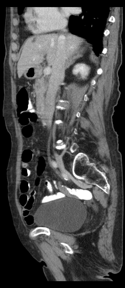 Adenocarcinoma of cecum (Radiopaedia 59222-66549 Sagittal C+ portal venous phase 58).jpg