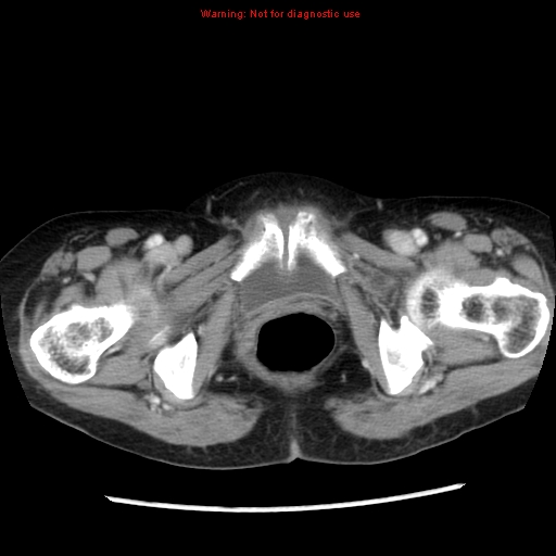 Adenocarcinoma of the colon (Radiopaedia 8191-9039 Axial liver window 75).jpg