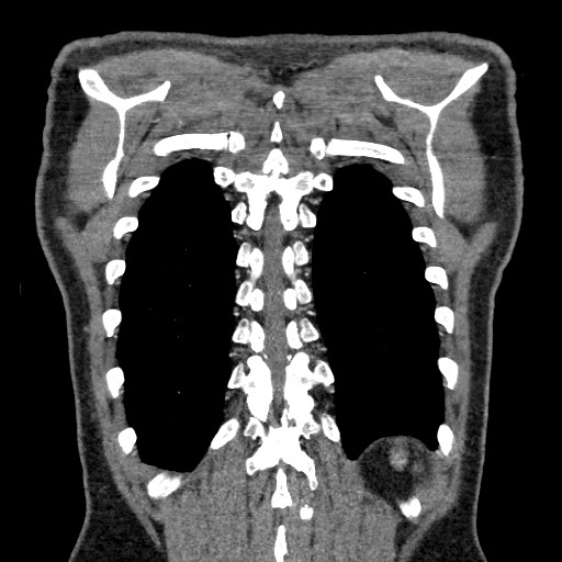 Adenocarcinoma of the lung (Radiopaedia 59871-67325 Coronal C+ arterial phase 64).jpg