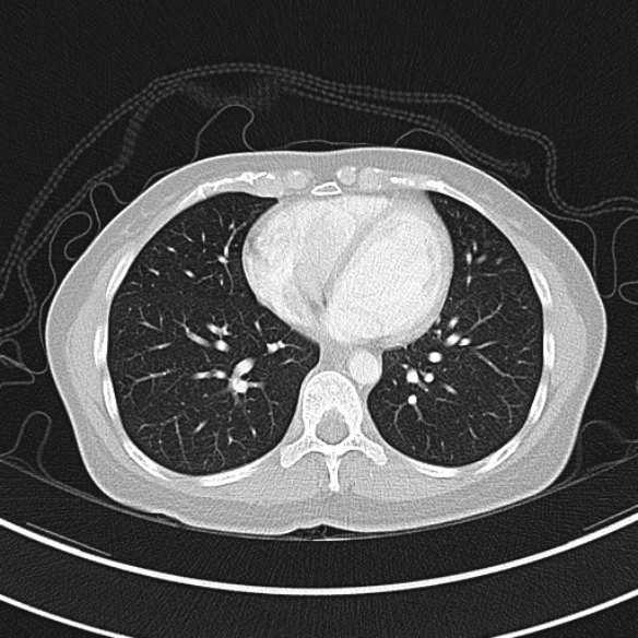 Adenocystic carcinoma of the trachea (Radiopaedia 47677-52525 Axial lung window 62).jpg