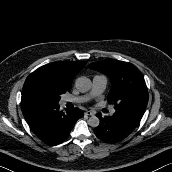 File:Adenoid cystic carcinoma of the trachea (Radiopaedia 49042-54137 Axial non-contrast 167).jpg
