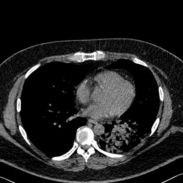Adenoid cystic carcinoma of the trachea (Radiopaedia 49042-54137 Axial non-contrast 210).jpg