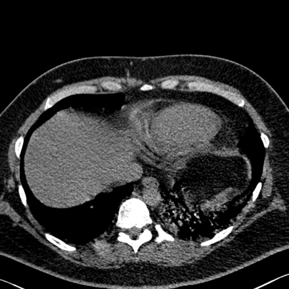 Adenoid cystic carcinoma of the trachea (Radiopaedia 49042-54137 Axial non-contrast 275).jpg