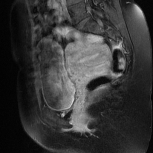 File:Adenoma malignum of cervix (Radiopaedia 66441-75705 Sagittal T1 C+ fat sat 8).jpg