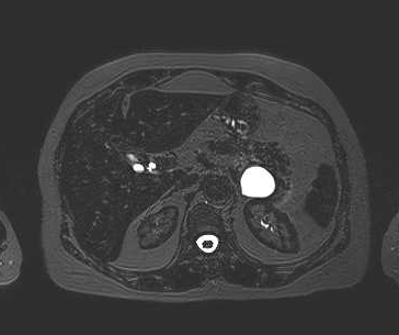 File:Adenomyomatosis of the gallbladder (Radiopaedia 50246-55587 Axial 68).png