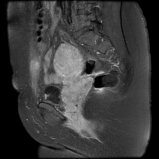 File:Adenomyosis-scar endometriosis (Radiopaedia 65863-75022 Sagittal T1 C+ fat sat 10).jpg