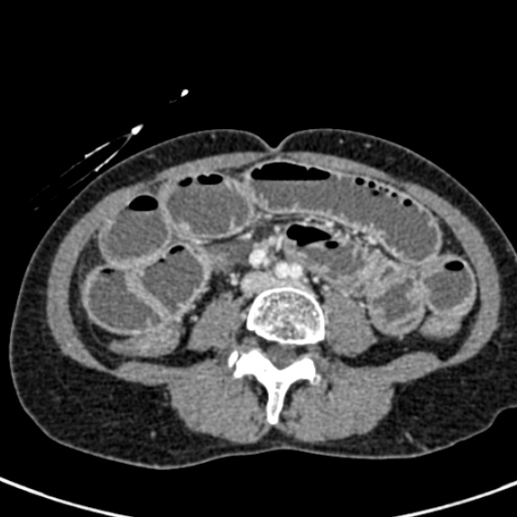 File:Adhesional small bowel obstruction (Radiopaedia 48397-53305 Axial C+ portal venous phase 51).jpg