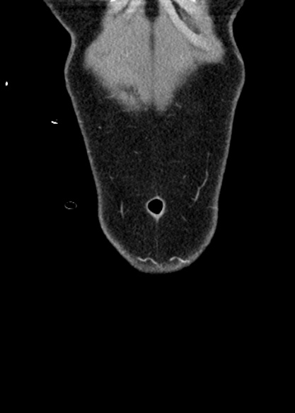 Adhesional small bowel obstruction (Radiopaedia 48397-53305 Coronal C+ portal venous phase 23).jpg