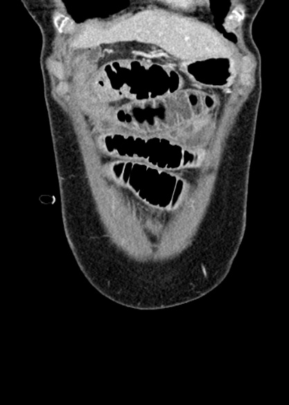 Adhesional small bowel obstruction (Radiopaedia 48397-53305 Coronal C+ portal venous phase 53).jpg