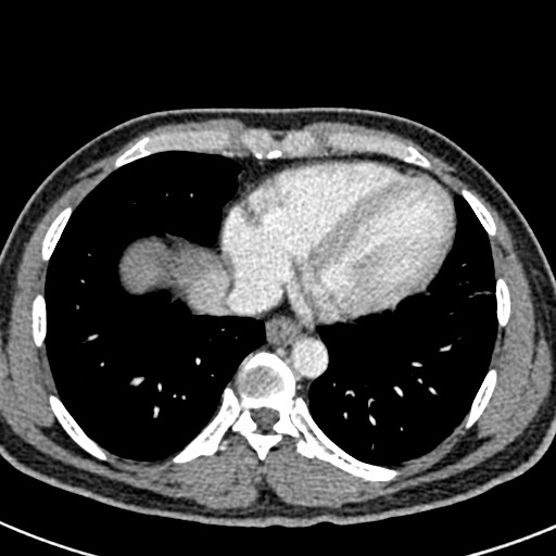 File:Adhesional small bowel obstruction (Radiopaedia 58900-66131 Axial C+ portal venous phase 3).jpg