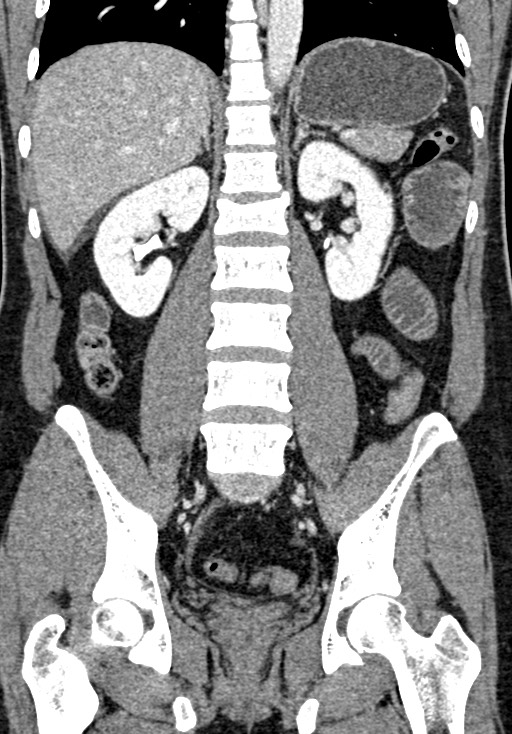 Adhesional small bowel obstruction (Radiopaedia 58900-66131 Coronal C+ portal venous phase 166).jpg