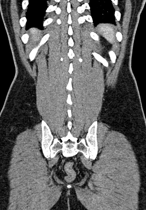 Adhesional small bowel obstruction (Radiopaedia 58900-66131 Coronal C+ portal venous phase 208).jpg